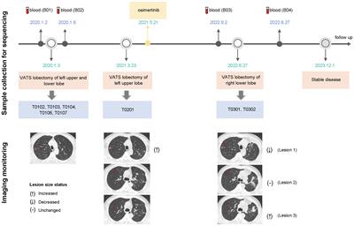 Case report: Targeted sequencing facilitates the diagnosis and management of rare multifocal pure ground-glass opacities with intrapulmonary metastasis